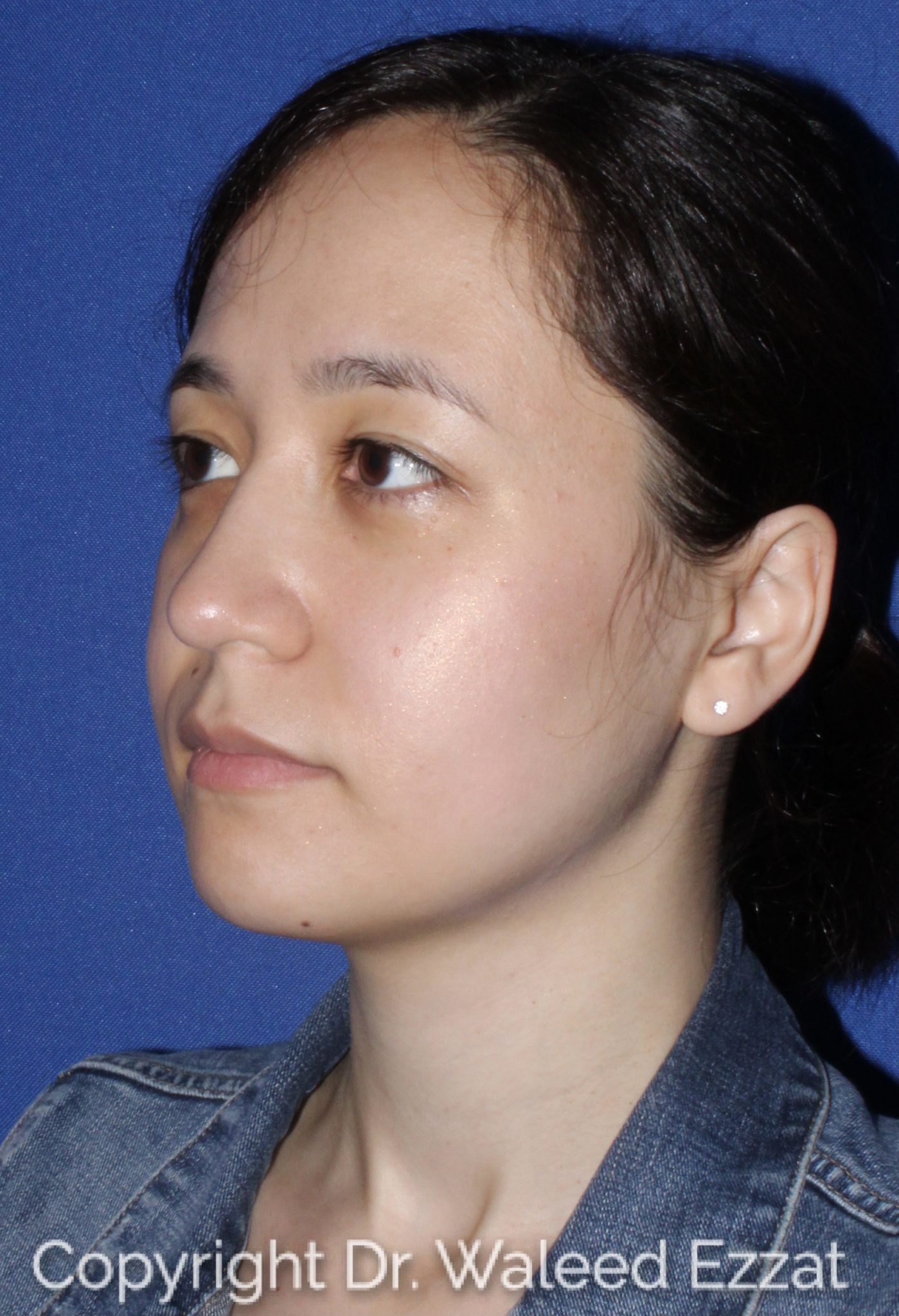 East Asian Rhinoplasty Patient Photo - Case 62 - after view-1