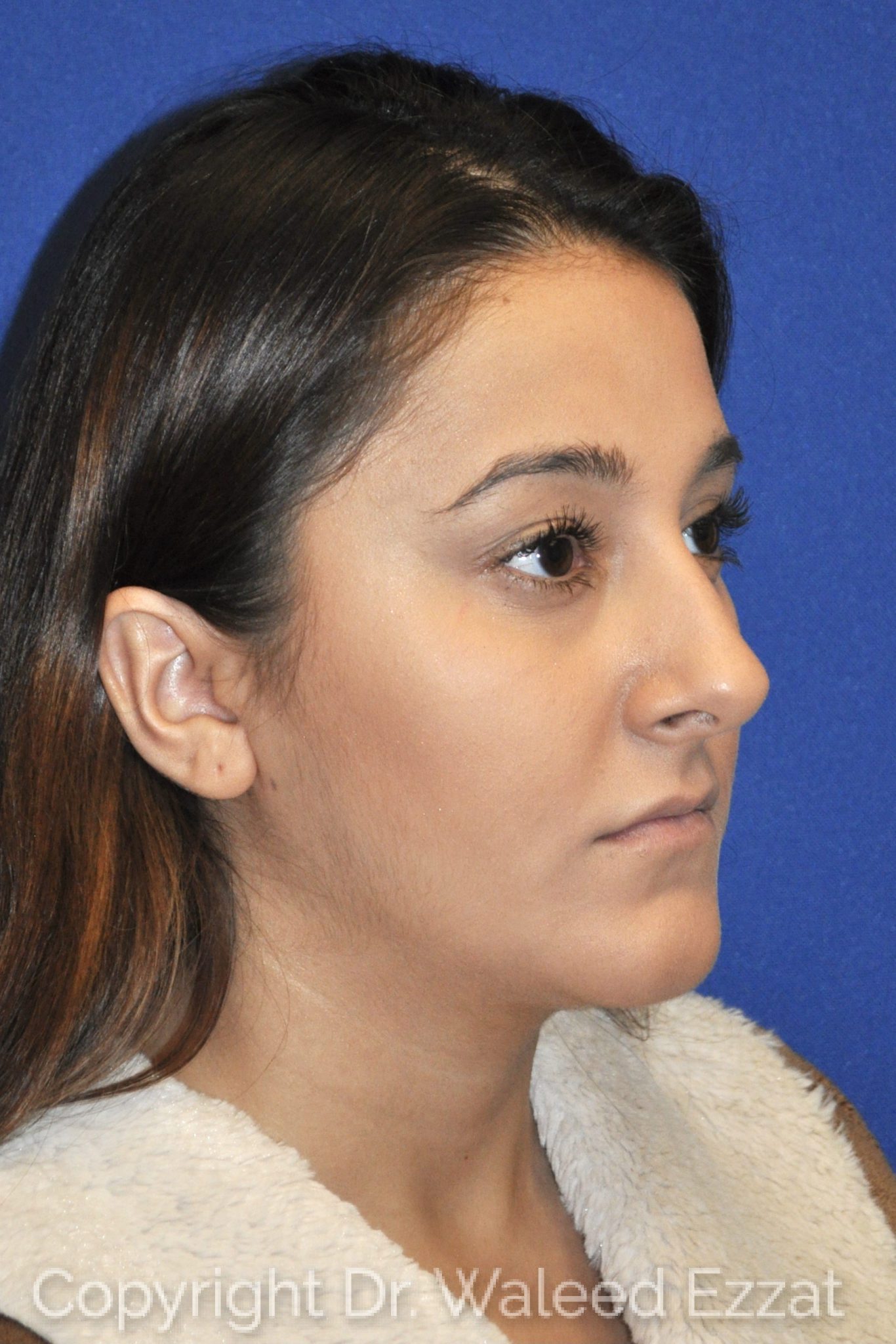 Hispanic/South American Rhinoplasty Patient Photo - Case 31 - before view-1