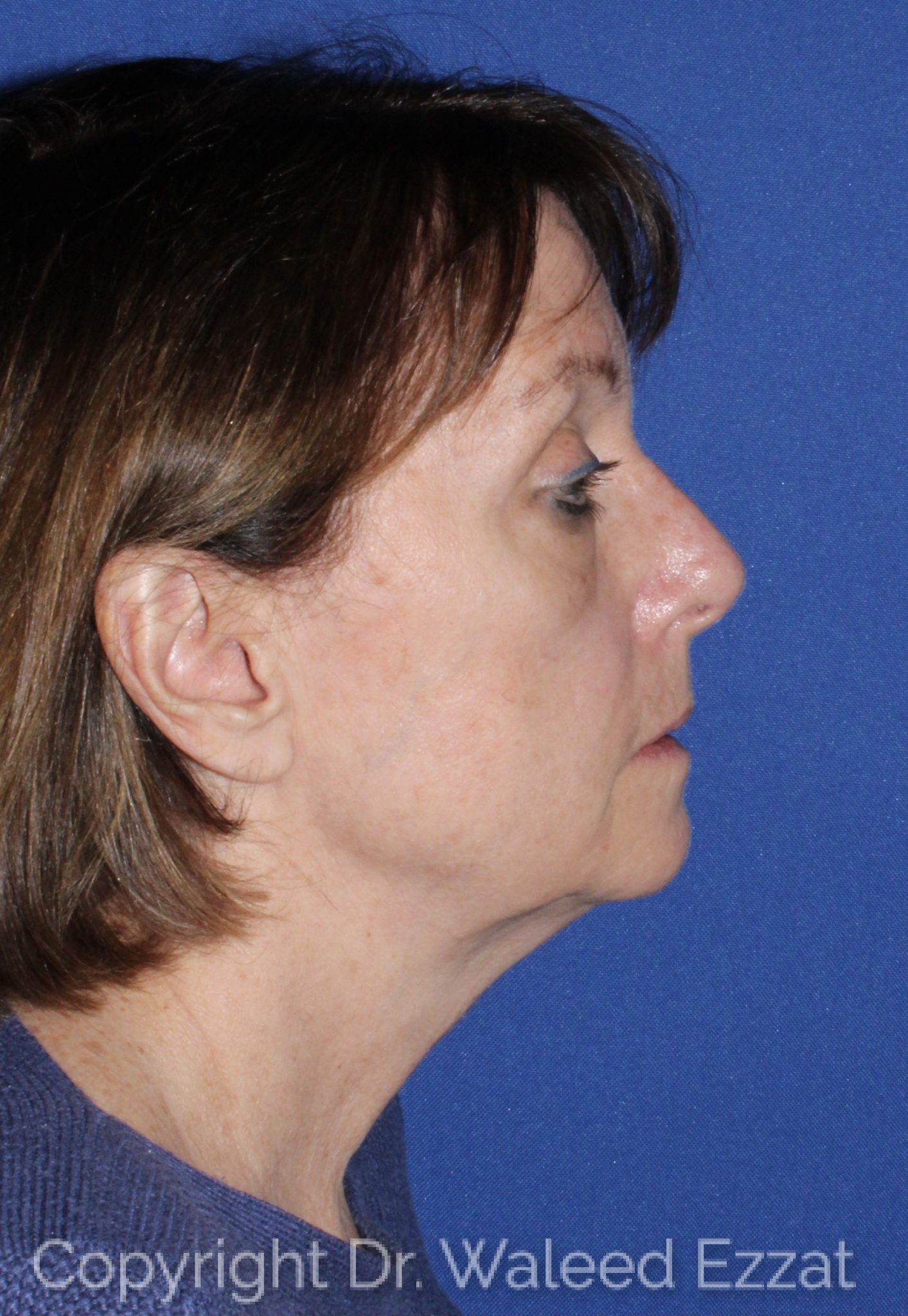 Blepharoplasty Patient Photo - Case 3 - before view-2