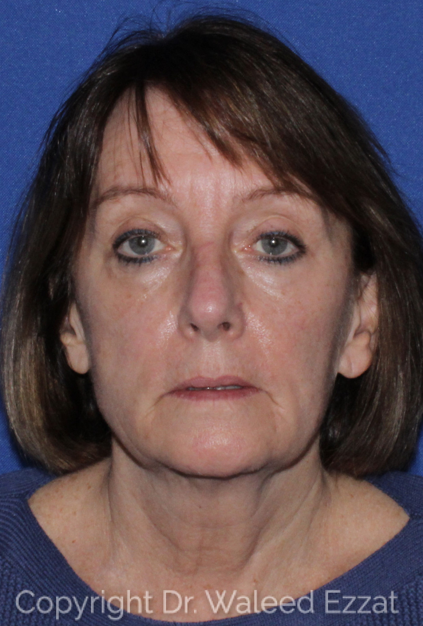 Blepharoplasty Patient Photo - Case 3 - before view-0