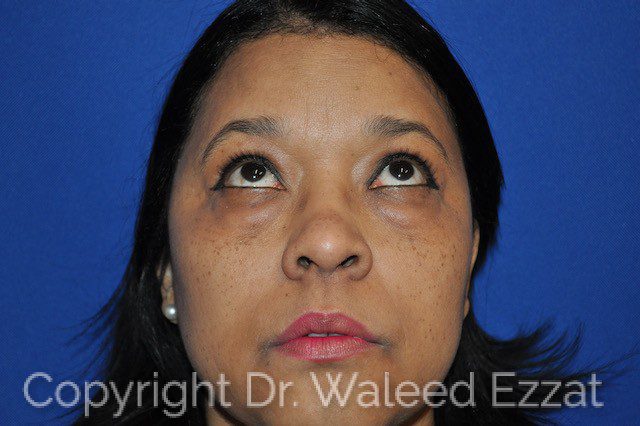 Blepharoplasty Patient Photo - Case 4718 - before view-
