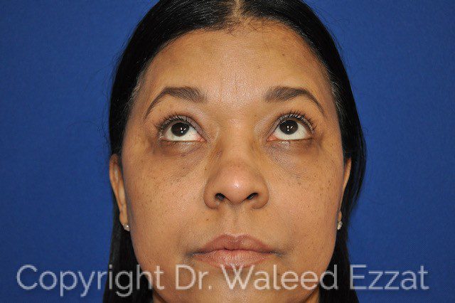 Blepharoplasty Patient Photo - Case 4718 - after view-0