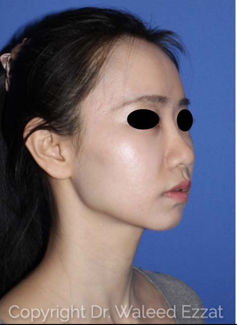 East Asian Rhinoplasty Patient Photo - Case 117 - after view-2