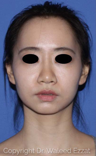 East Asian Rhinoplasty Patient Photo - Case 117 - after view-1