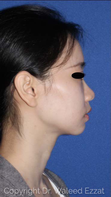 East Asian Rhinoplasty Patient Photo - Case 117 - before view-0