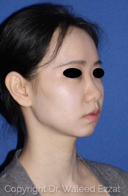 East Asian Rhinoplasty Patient Photo - Case 117 - before view-2