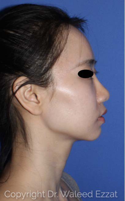 East Asian Rhinoplasty Patient Photo - Case 117 - after view-0