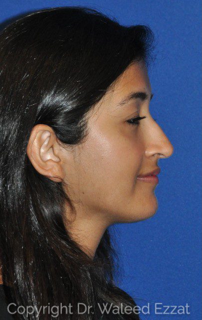 Rhinoplasty Patient Photo - Case 6619 - before view-0