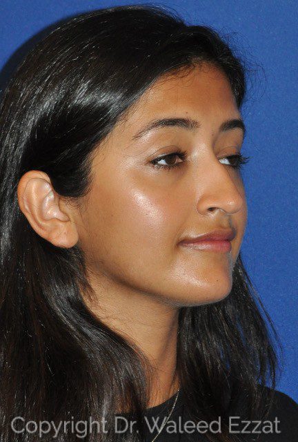 Rhinoplasty Patient Photo - Case 6619 - before view-1