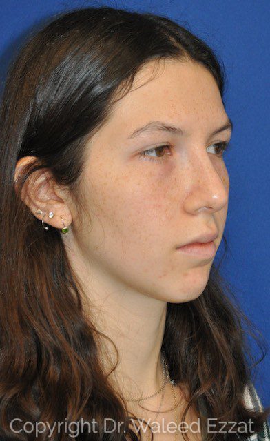 Hispanic/South American Rhinoplasty Patient Photo - Case 6639 - after view-1