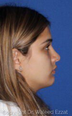 Chin Augmentation - Case 6647 - After
