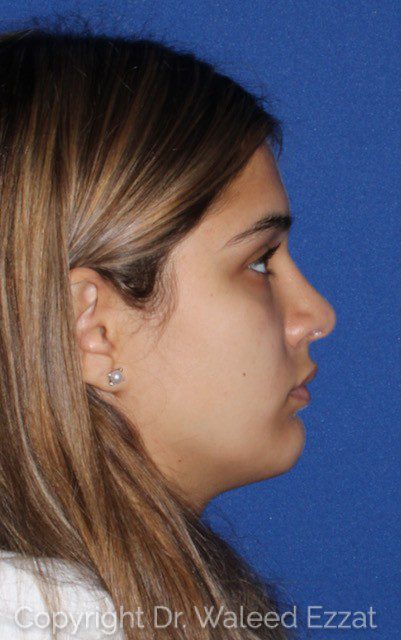 Chin Augmentation Patient Photo - Case 6647 - after view