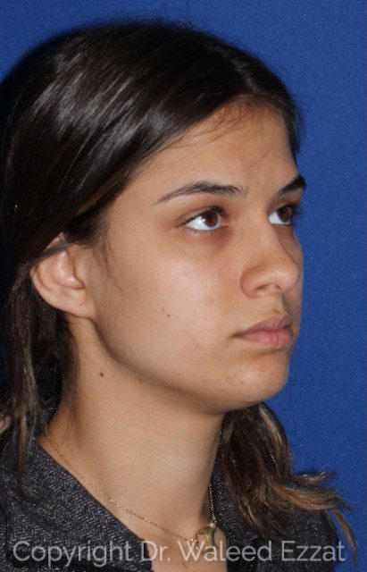 Chin Augmentation Patient Photo - Case 6647 - before view-1