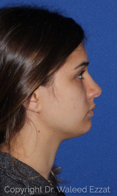 Chin Augmentation Patient Photo - Case 6647 - before view-