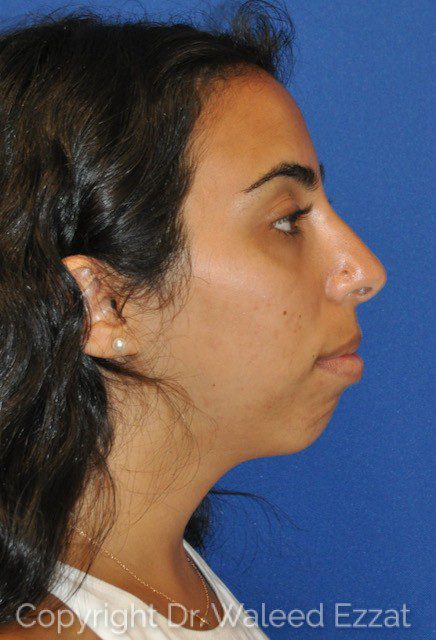Chin Augmentation Patient Photo - Case 6867 - before view-