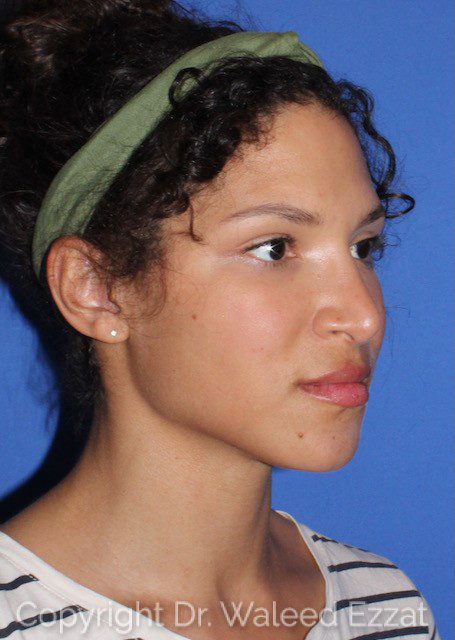 African/Caribbean Rhinoplasty Patient Photo - Case 7607 - after view-1