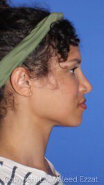 African/Caribbean Rhinoplasty - Case 7607 - After