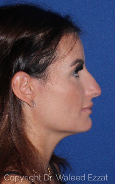 Mediterranean/Middle Eastern Rhinoplasty Patient Photo - Case 7033 - before view-0