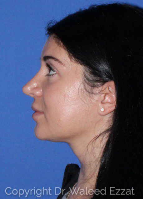 Mediterranean/Middle Eastern Rhinoplasty Patient Photo - Case 7039 - after view-0