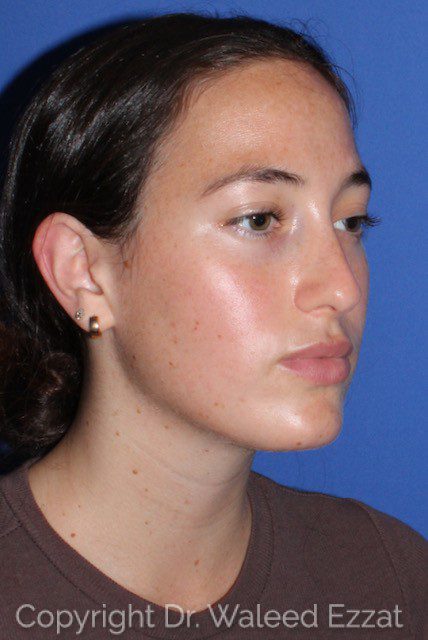 Revision Rhinoplasty Patient Photo - Case 7051 - before view-2
