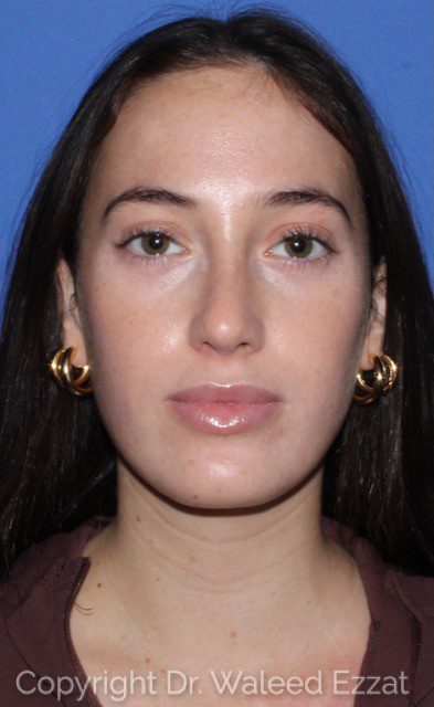 Revision Rhinoplasty Patient Photo - Case 7051 - after view-1