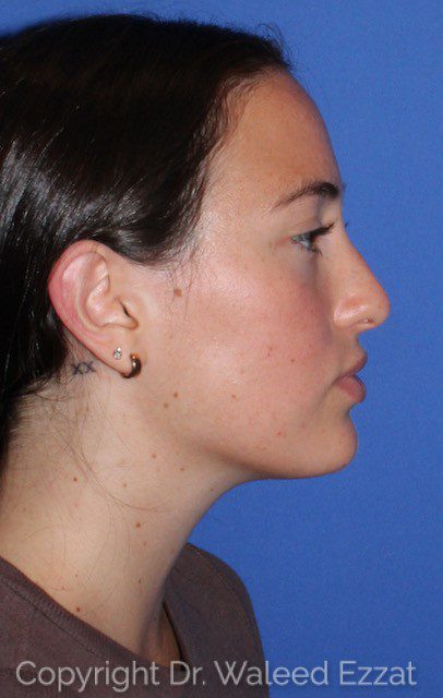 Revision Rhinoplasty Patient Photo - Case 7051 - before view-