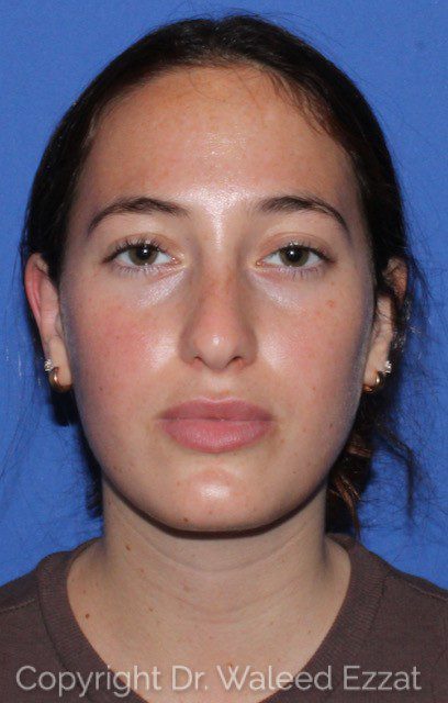Revision Rhinoplasty Patient Photo - Case 7051 - before view-1