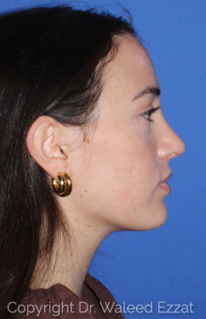 Revision Rhinoplasty Patient Photo - Case 7051 - after view-0