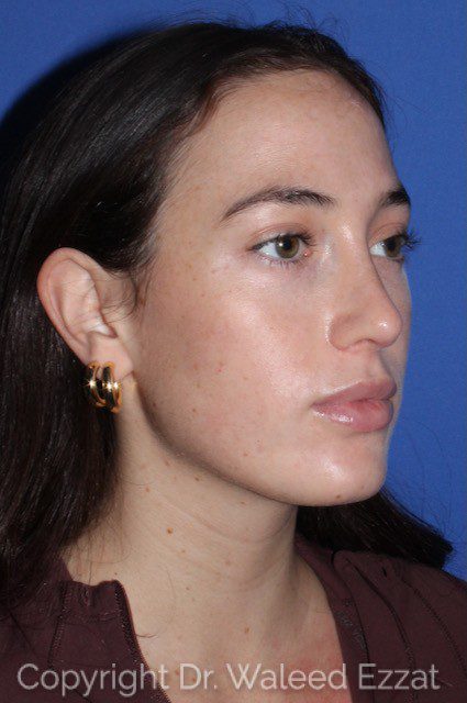 Revision Rhinoplasty Patient Photo - Case 7051 - after view-2