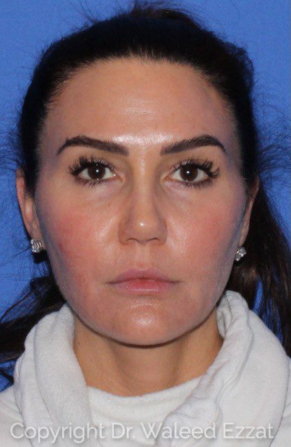 Revision Rhinoplasty Patient Photo - Case 7091 - after view-2