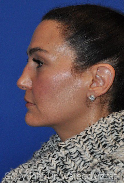 Revision Rhinoplasty Patient Photo - Case 7091 - before view-