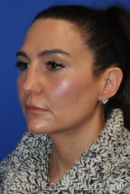 Revision Rhinoplasty Patient Photo - Case 7091 - before view-1