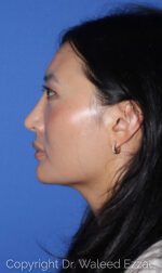 East Asian Rhinoplasty - Case 7502 - After